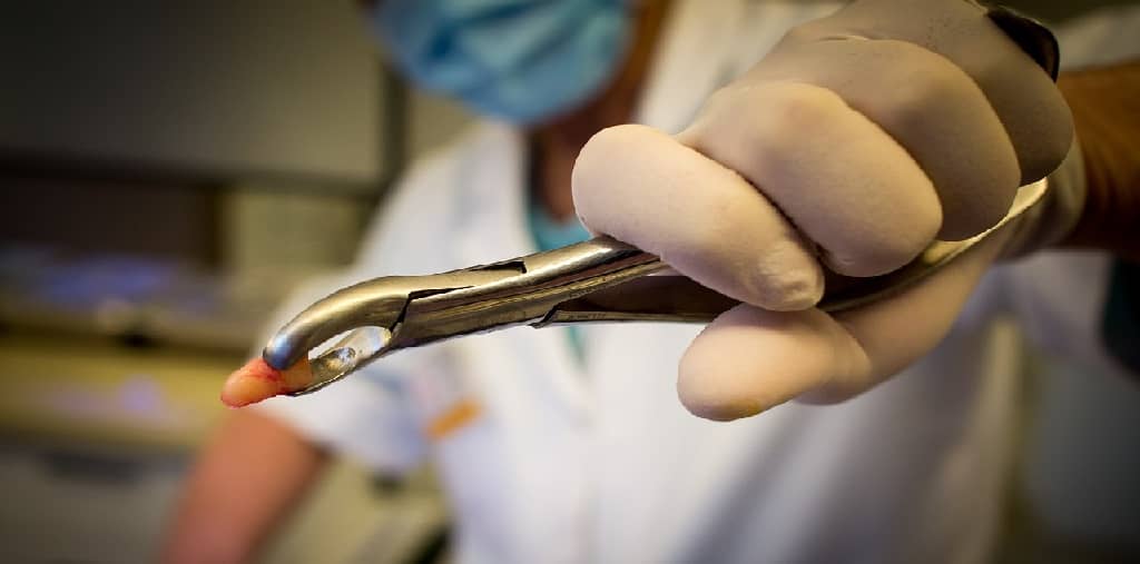 Tooth extraction